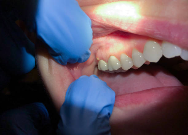 Emergency Dental Filling Replacement in RI